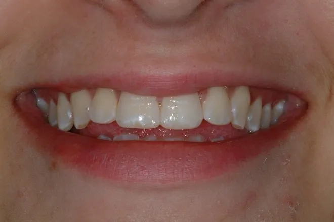 Instant Orthodontics Santa Rosa CA | Straighten Teeth